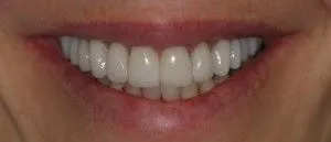 The image shows a person with a wide smile, revealing straight white teeth and a bright smile, set against a neutral background.