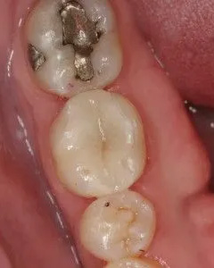 The image shows a close-up view of a person's mouth with teeth that appear damaged, possibly due to decay or other dental issues, with some areas having gold fillings, and the interior of the mouth is visible with tongue and gums.