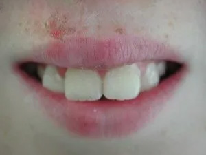 The image shows a close-up of a person s face with a wide smile, revealing teeth and lips, against a blurred background.