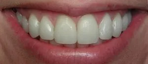 The image displays a close-up of a person s smiling mouth with white teeth, showing a broad smile with visible lipstick.