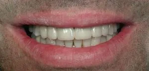 The image shows a close-up of a person s mouth with teeth, featuring a large smile and a visible red lipstick application.