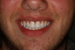The image shows a close-up of a person s face with a wide smile, revealing white teeth, against a darker background.