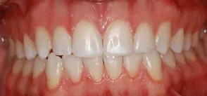 The image shows a close-up view of teeth with a noticeable red gum line, likely indicating poor oral hygiene or an underlying dental issue.