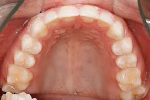 The image shows a close-up view of an open mouth with multiple teeth, some of which appear damaged or discolored, against a background that includes a partial view of a dental device or appliance.