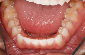 The image shows a close-up view of an oral cavity with visible teeth, gums, and tongue, highlighting dental health concerns such as tooth decay or infection.