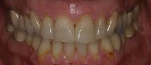 The image shows a close-up of a mouth with severe dental decay and discoloration, featuring numerous rotten teeth with exposed roots and yellowish stains, against a pink background that could be interpreted as a tongue or gum tissue.