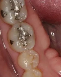 The image shows a close-up view of a mouth with multiple teeth missing, revealing a damaged oral structure.