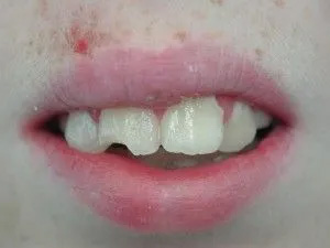 The image shows a close-up of a person s face with a focus on their teeth and lips, set against a plain background.