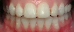 An open mouth displaying a set of teeth with a focus on the bottom front teeth, showcasing a wide smile.