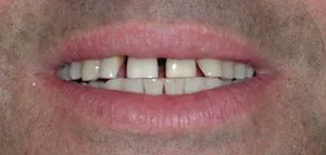 The image shows a close-up of a person s mouth with teeth, including one with a gap, smiling broadly.