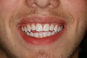 The image shows a person with a wide smile revealing straight white teeth, set against a grey background with their face occupying most of the frame.