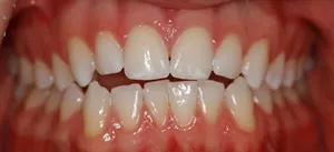 The image shows a close-up view of a person s teeth with visible stains and gaps, against a blurred background.