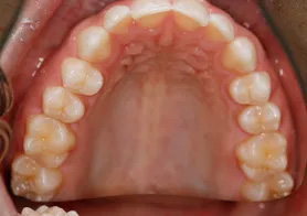 The image shows a close-up view of an open mouth with visible teeth and gums, focusing on dental decay and damage.