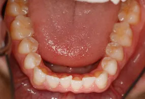 The image shows an open mouth with teeth and the tongue exposed, displaying a red, inflamed interior likely indicative of a medical condition such as gum disease or infection.