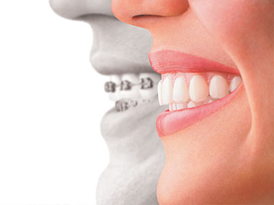 The image features a split-screen comparison of a person s natural smile on the left and an altered smile with braces on the right, emphasizing the transformation through orthodontic treatment.