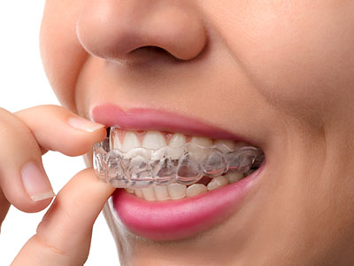 The image shows a person with straight white teeth holding a clear aligner, which appears to be part of an orthodontic treatment system.