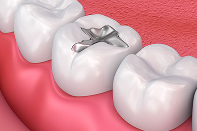 The image shows a close-up view of a human dental implant being surgically placed into a prepared tooth socket, with a focus on the metal implant.
