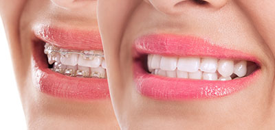 The image shows a close-up of two people with bright smiles, displaying their teeth and lips.