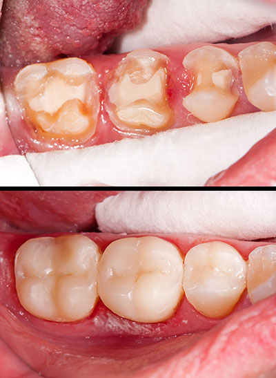 The image displays a close-up view of a person s mouth with severely decayed teeth and gum disease, emphasizing oral health issues.