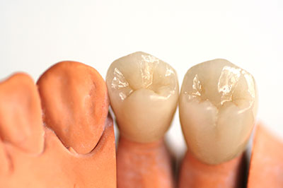 The image shows a set of artificial teeth with visible roots, likely used for dental implant demonstration or educational purposes.