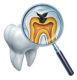 The image features a magnified view of a tooth with a cavity, showcasing the internal structure including the pulp chamber and roots, viewed through a microscope with a focus on the affected area.