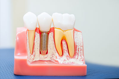 The image shows a close-up view of a dental implant fixture with a screw partially inserted into a red plastic model of a mouth, likely used for educational purposes to demonstrate dental implant placement.