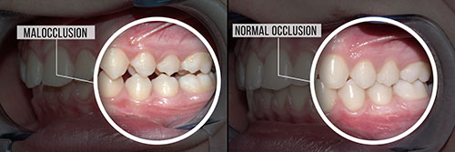 The image shows a series of photographs capturing the stages of tooth decay from normal to severe, with annotations indicating  Malocclusion  and a magnified view of a mouth with dental issues.