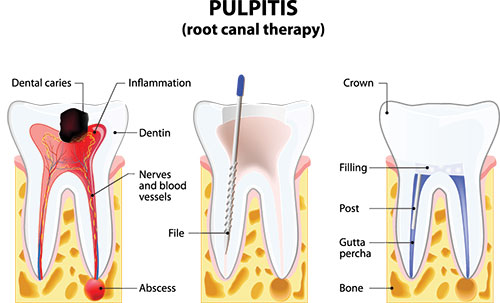 The image depicts a detailed diagrammatic illustration of the human teeth structure, with labels indicating various parts such as pulp, root canal therapy, dental caries, crown, filling, dentin, enamel, tooth decay, and gums.