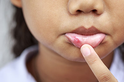 This is a close-up photograph of a person with a pimple on their face, holding their finger near it, possibly examining it.