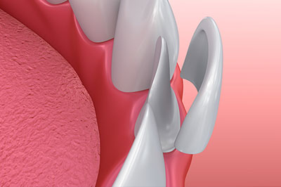 The image shows a close-up view of a dental implant with visible screws and a pink gum-like substance, likely a simulation or model used for educational or illustrative purposes.