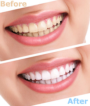 The image displays a before-and-after comparison of teeth whitening, featuring two pictures of a person s smile with varying degrees of brightness.