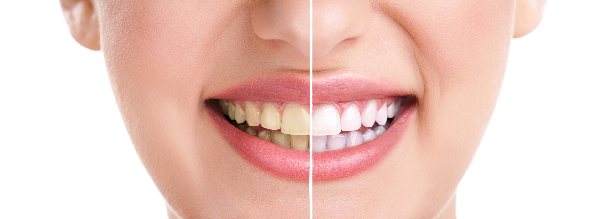 A close-up of a smiling woman with teeth whitening treatment applied, set against a white background with a transparent overlay showing the before and after comparison.
